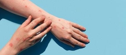 Cascavel registra o sétimo caso de Monkeypox